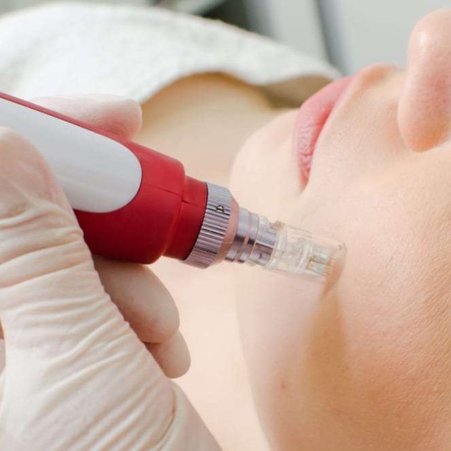 MICRO-NEEDLING